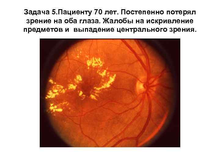 Задача 5. Пациенту 70 лет. Постепенно потерял зрение на оба глаза. Жалобы на искривление