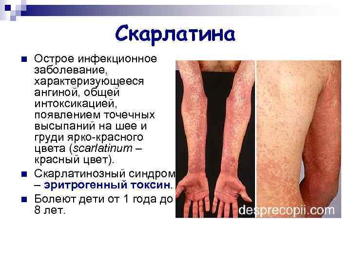 Скарлатина n n n Острое инфекционное заболевание, характеризующееся ангиной, общей интоксикацией, появлением точечных высыпаний