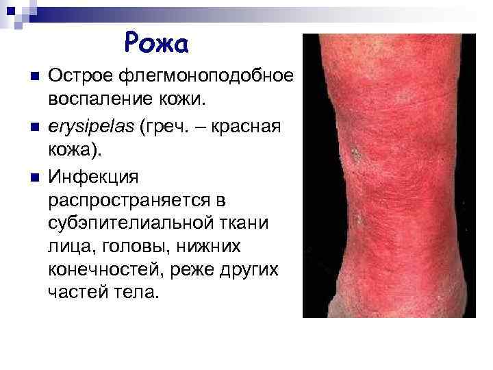 Рожа n n n Острое флегмоноподобное воспаление кожи. erysipelas (греч. – красная кожа). Инфекция