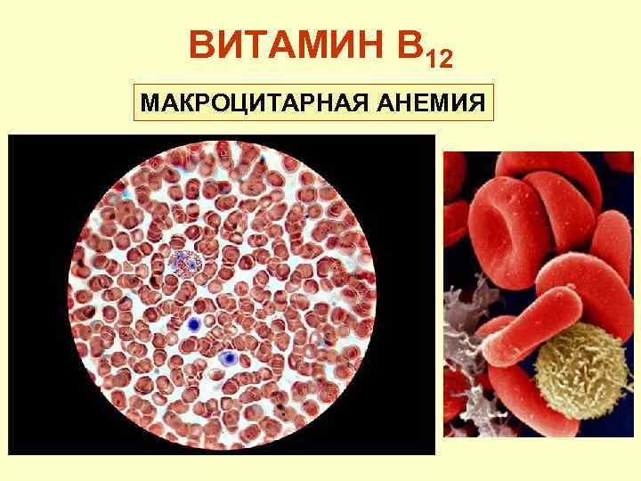 ВИТАМИН В 12 МАКРОЦИТАРНАЯ АНЕМИЯ 