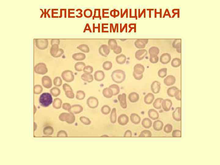 ЖЕЛЕЗОДЕФИЦИТНАЯ АНЕМИЯ 