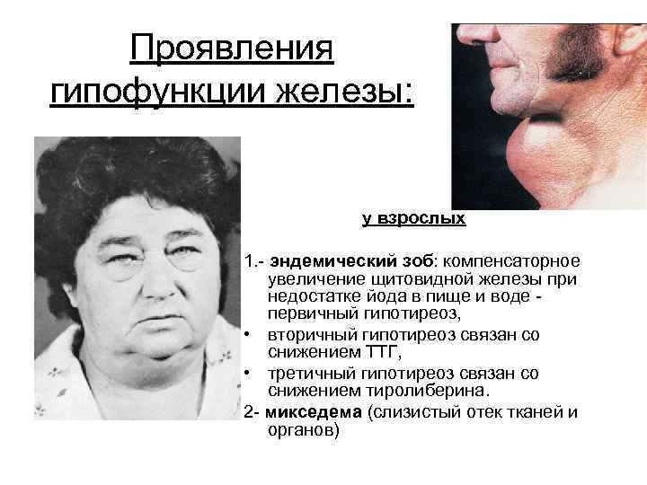 Гипофункция железы