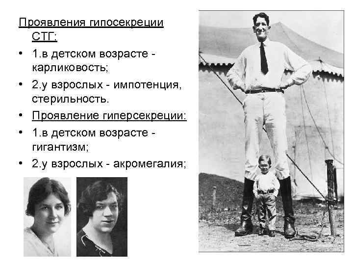 Проявления гипосекреции СТГ: • 1. в детском возрасте карликовость; • 2. у взрослых импотенция,