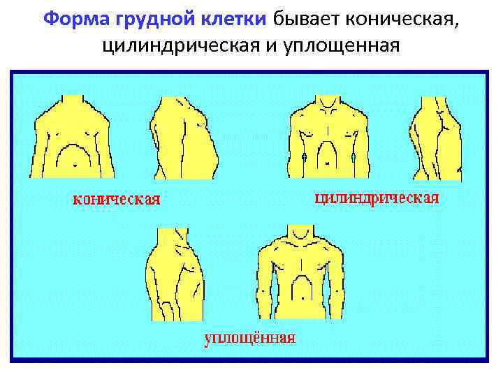 Ладьевидная грудная клетка рисунок