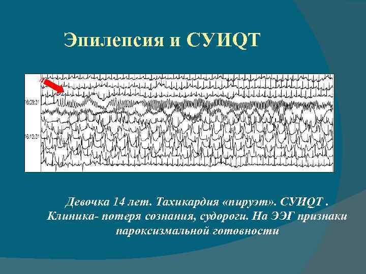 Эпилепсия и СУИQT Девочка 14 лет. Тахикардия «пируэт» . CУИQT. Клиника- потеря сознания, судороги.