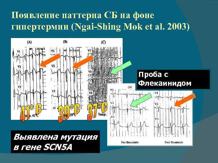 Появление паттерна СБ на фоне гипертермии (Ngai-Shing Mok et al. 2003) Проба с Флекаинидом