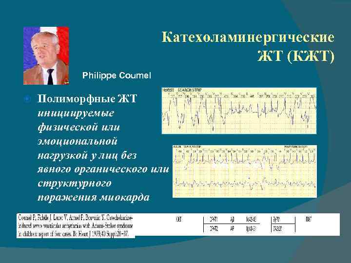 Катехоламинергические ЖТ (КЖТ) Philippe Coumel Полиморфные ЖТ инициируемые физической или эмоциональной нагрузкой у лиц