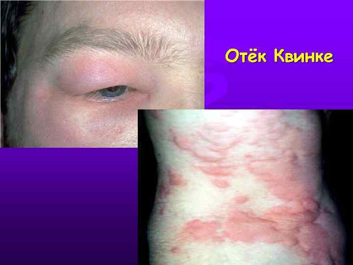 Отёк Квинке 