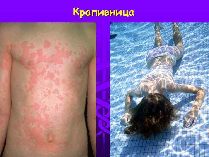 Крапивница 