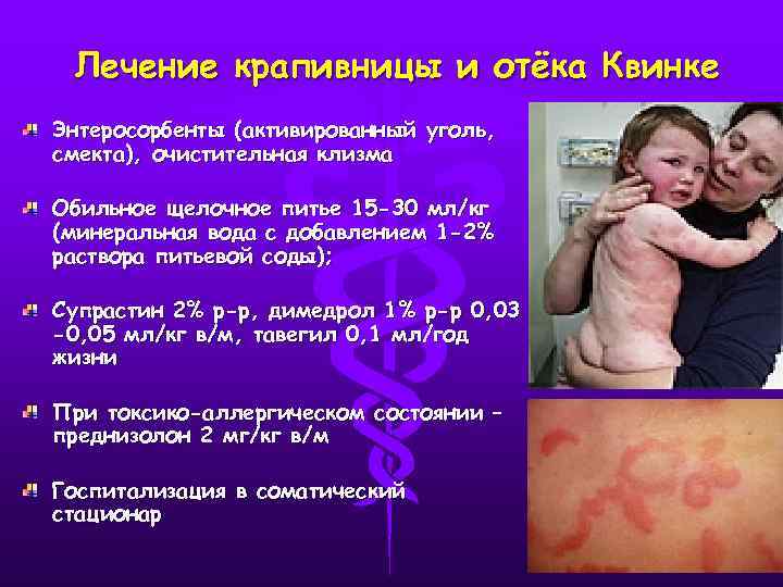 Лечение крапивницы и отёка Квинке Энтеросорбенты (активированный уголь, смекта), очистительная клизма Обильное щелочное питье