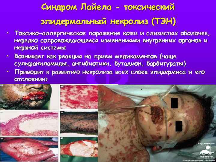 Синдром Лайела - токсический эпидермальный некролиз (ТЭН) • Токсико-аллергическое поражение кожи и слизистых оболочек,