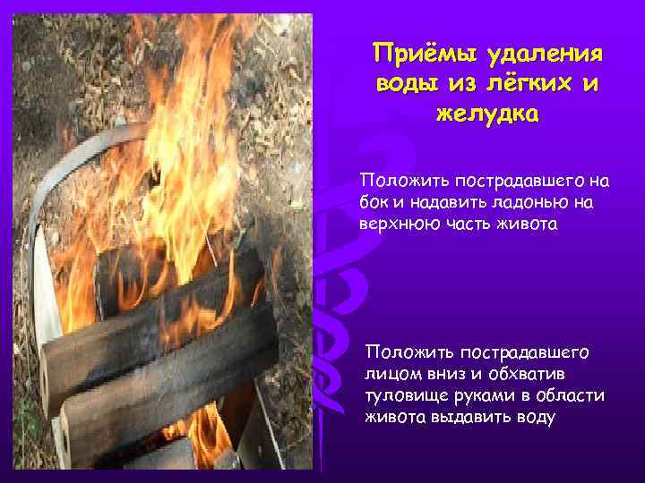 Приёмы удаления воды из лёгких и желудка Положить пострадавшего на бок и надавить ладонью