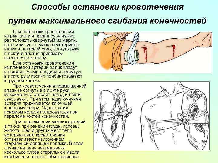 Способы остановки кровотечения путем максимального сгибания конечностей Для остановки кровотечения из ран кисти и