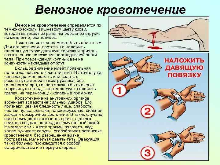 Способ остановки венозного кровотечения наложение жгута