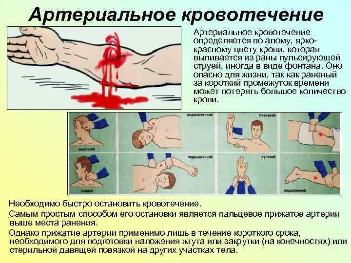 Артериальное кровотечение определяется по алому, яркокрасному цвету крови, которая выливается из раны пульсирующей струей,