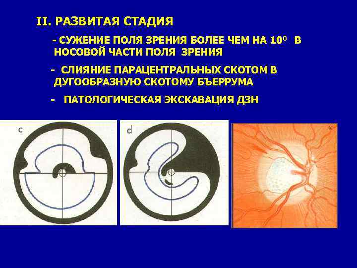 II. РАЗВИТАЯ СТАДИЯ - СУЖЕНИЕ ПОЛЯ ЗРЕНИЯ БОЛЕЕ ЧЕМ НА 100 В - НОСОВОЙ