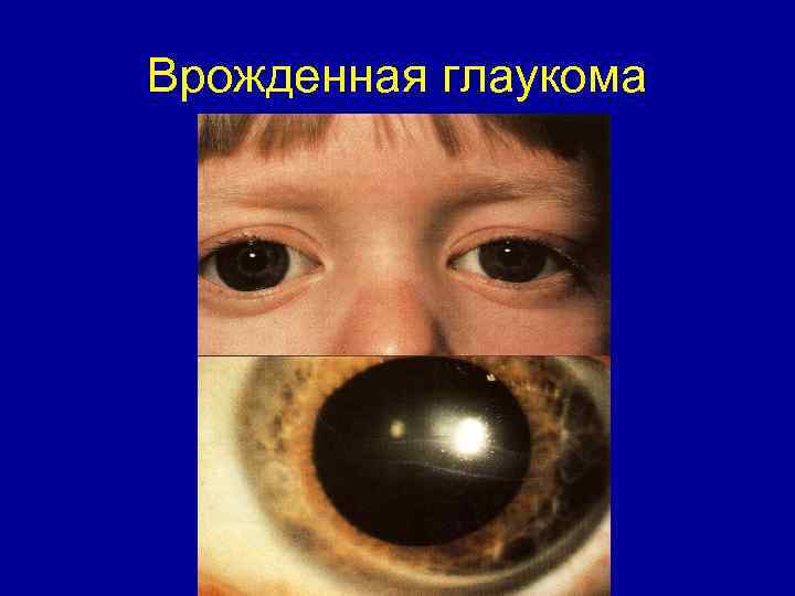Врожденная глаукома 
