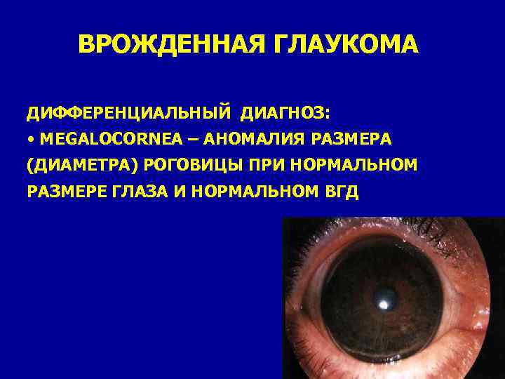 Глаукома лекция для пациентов thumbnail