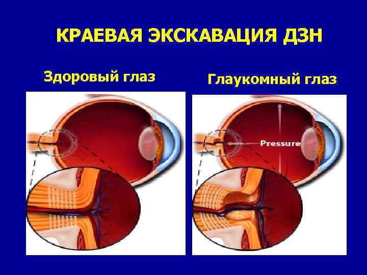 Глаукома учебник по офтальмологии thumbnail