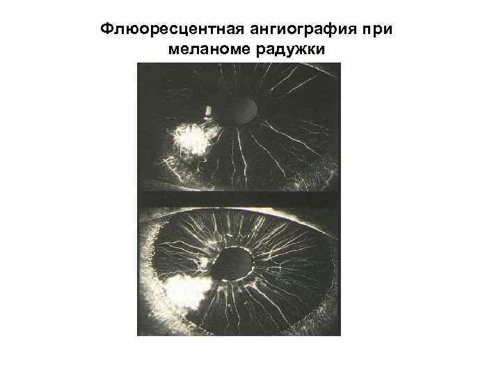 Флюоресцентная ангиография при меланоме радужки 