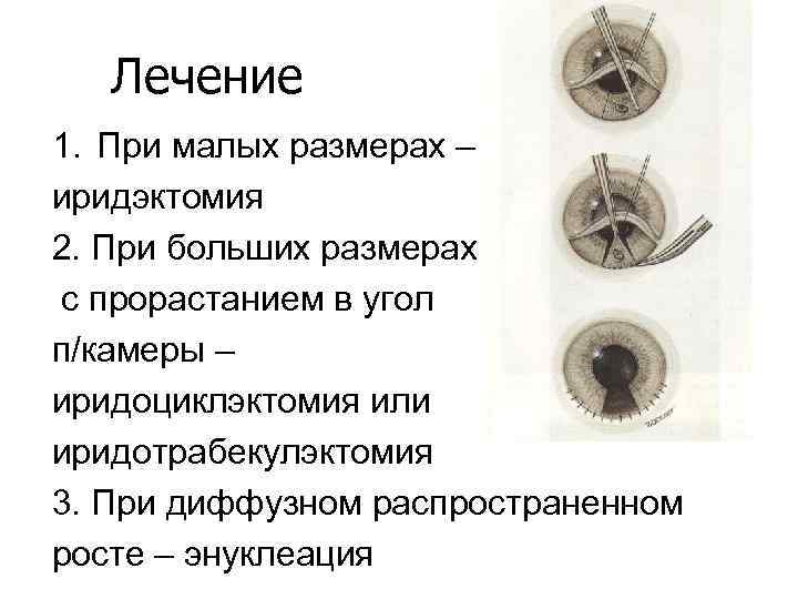 Лечение 1. При малых размерах – иридэктомия 2. При больших размерах с прорастанием в