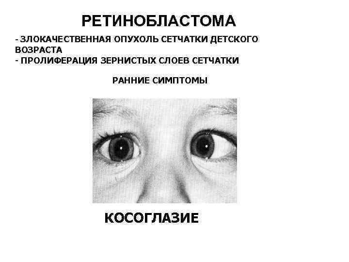РЕТИНОБЛАСТОМА - ЗЛОКАЧЕСТВЕННАЯ ОПУХОЛЬ СЕТЧАТКИ ДЕТСКОГО ВОЗРАСТА - ПРОЛИФЕРАЦИЯ ЗЕРНИСТЫХ СЛОЕВ СЕТЧАТКИ РАННИЕ СИМПТОМЫ