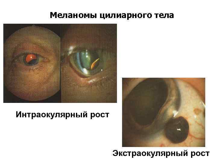 Меланомы цилиарного тела Интраокулярный рост Экстраокулярный рост 