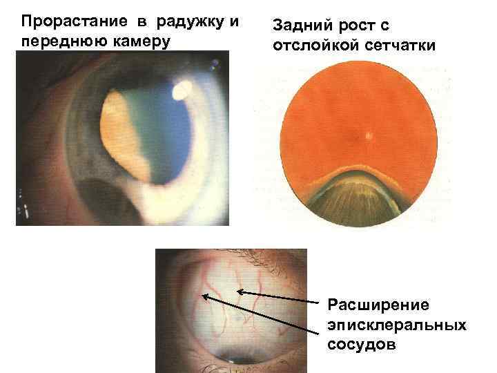 Прорастание в радужку и переднюю камеру Задний рост с отслойкой сетчатки Расширение эписклеральных сосудов