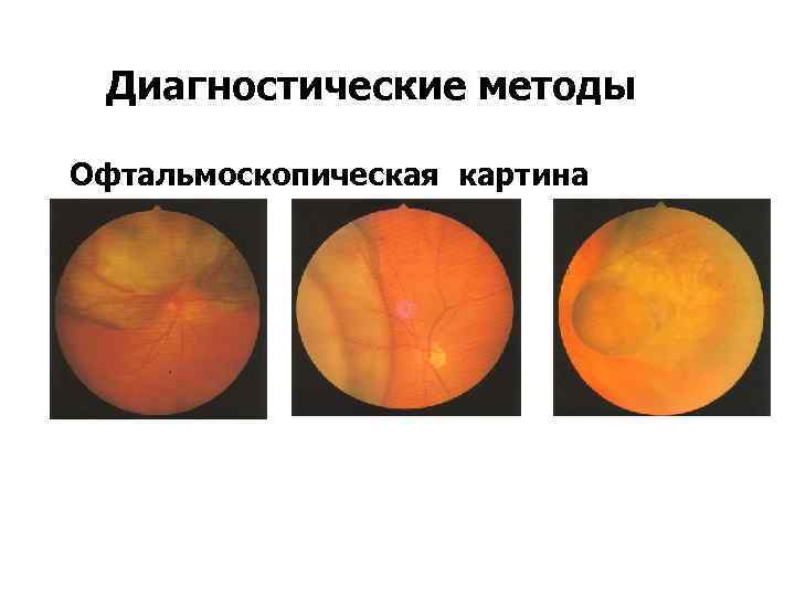 Диагностические методы Офтальмоскопическая картина 