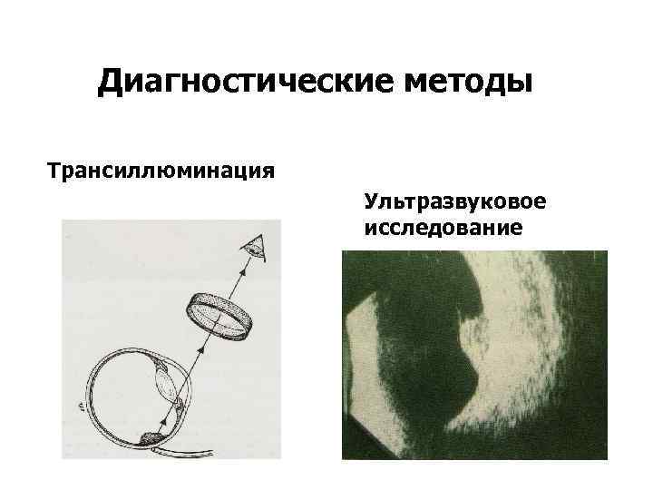 Диагностические методы Трансиллюминация Ультразвуковое исследование 