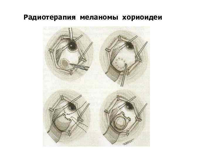 Радиотерапия меланомы хориоидеи 