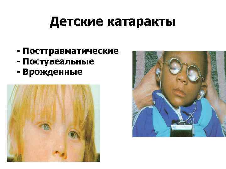 Детские катаракты - Посттравматические - Постувеальные - Врожденные 