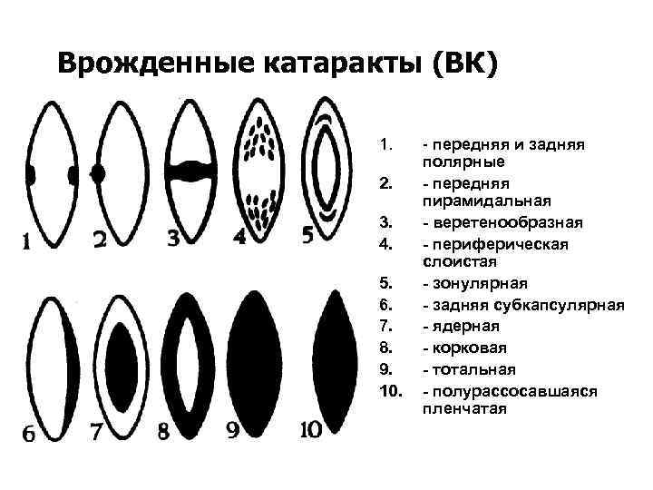 Катаракта схема