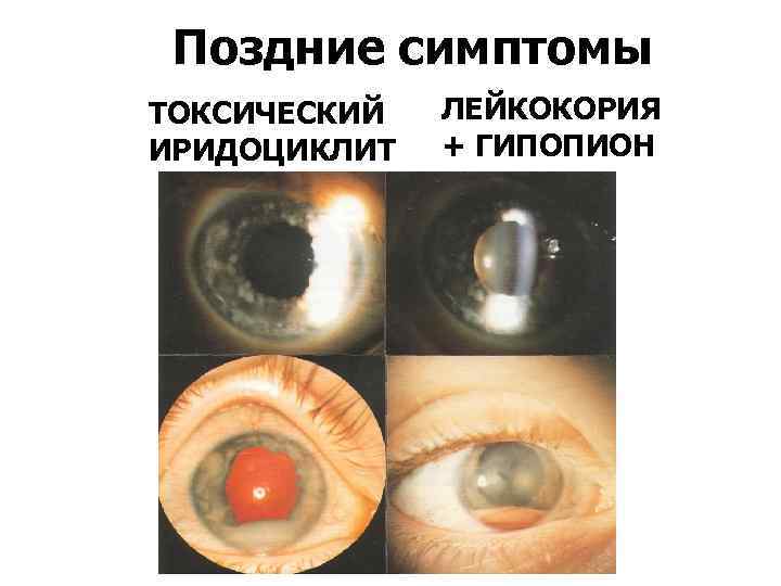 Поздние симптомы ТОКСИЧЕСКИЙ ИРИДОЦИКЛИТ ЛЕЙКОКОРИЯ + ГИПОПИОН 