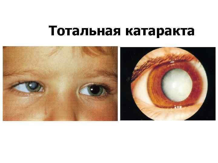 Тотальная катаракта 