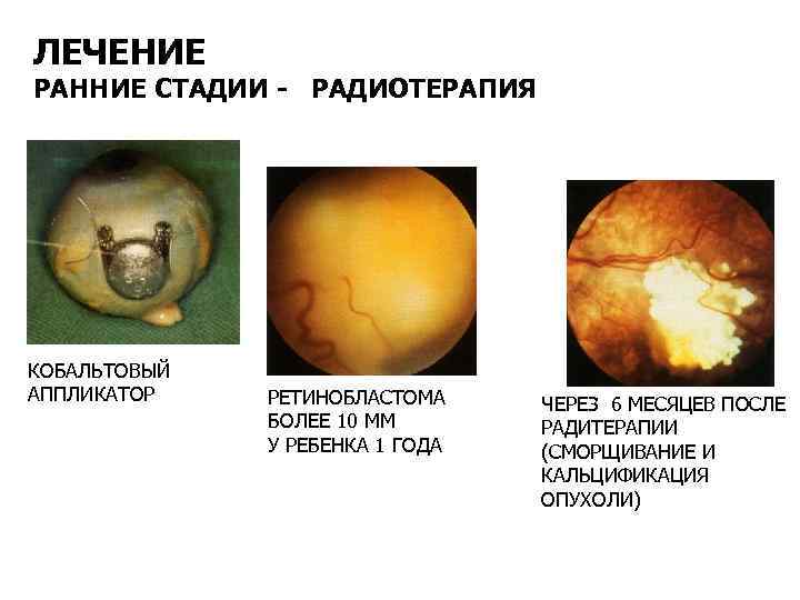 ЛЕЧЕНИЕ РАННИЕ СТАДИИ - РАДИОТЕРАПИЯ КОБАЛЬТОВЫЙ АППЛИКАТОР РЕТИНОБЛАСТОМА БОЛЕЕ 10 ММ У РЕБЕНКА 1