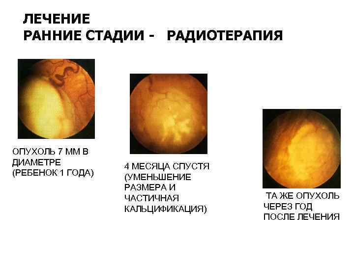 ЛЕЧЕНИЕ РАННИЕ СТАДИИ - РАДИОТЕРАПИЯ ОПУХОЛЬ 7 ММ В ДИАМЕТРЕ (РЕБЕНОК 1 ГОДА) 4