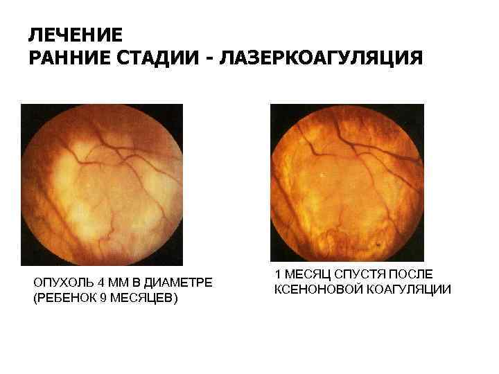 ЛЕЧЕНИЕ РАННИЕ СТАДИИ - ЛАЗЕРКОАГУЛЯЦИЯ ОПУХОЛЬ 4 ММ В ДИАМЕТРЕ (РЕБЕНОК 9 МЕСЯЦЕВ) 1