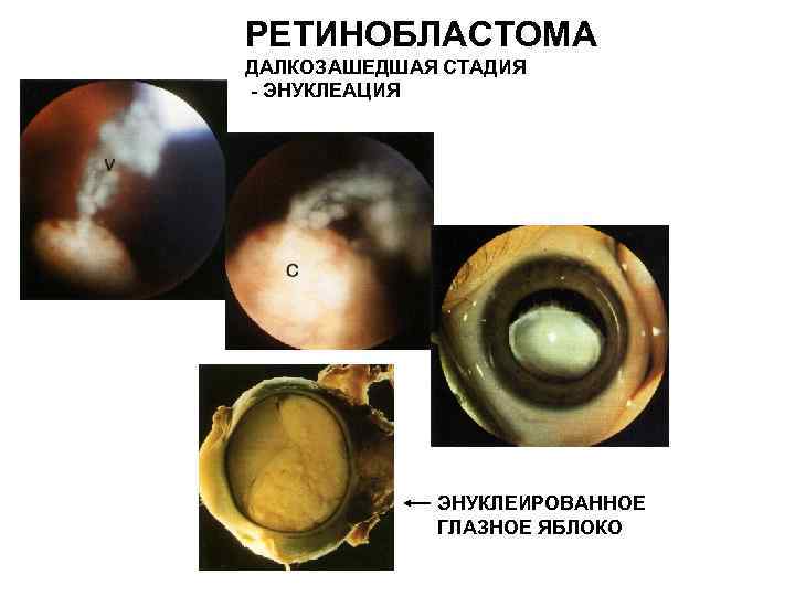 РЕТИНОБЛАСТОМА ДАЛКОЗАШЕДШАЯ СТАДИЯ - ЭНУКЛЕАЦИЯ ЭНУКЛЕИРОВАННОЕ ГЛАЗНОЕ ЯБЛОКО 