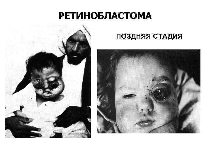 РЕТИНОБЛАСТОМА ПОЗДНЯЯ СТАДИЯ 