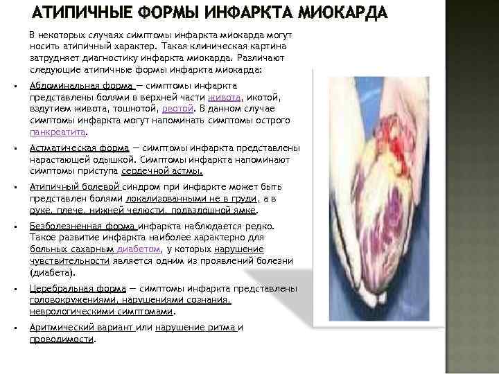АТИПИЧНЫЕ ФОРМЫ ИНФАРКТА МИОКАРДА В некоторых случаях симптомы инфаркта миокарда могут носить атипичный характер.