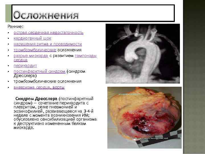 Ранние: • острая сердечная недостаточность • кардиогенный шок • нарушения ритма и проводимости •