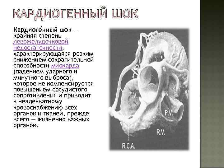 Кардиоге нный шок — крайняя степень левожелудочковой недостаточности, характеризующаяся резким снижением сократительной способности миокарда