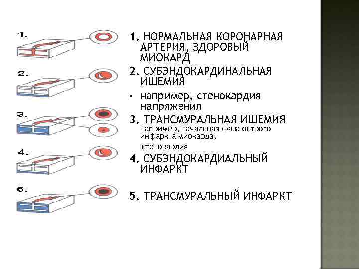 1. НОРМАЛЬНАЯ КОРОНАРНАЯ АРТЕРИЯ, ЗДОРОВЫЙ МИОКАРД 2. СУБЭНДОКАРДИНАЛЬНАЯ ИШЕМИЯ · например, стенокардия напряжения 3.