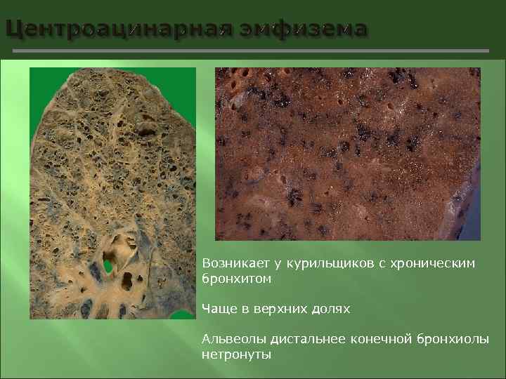 Возникает у курильщиков с хроническим бронхитом Чаще в верхних долях Альвеолы дистальнее конечной бронхиолы