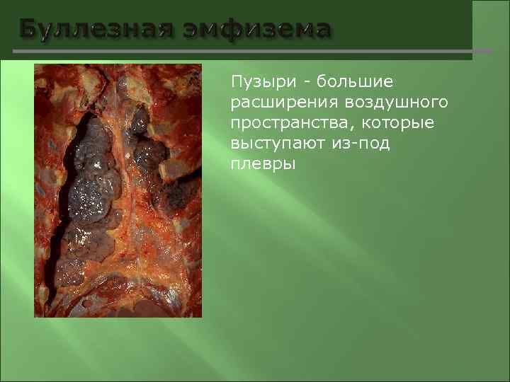 Пузыри - большие расширения воздушного пространства, которые выступают из-под плевры 