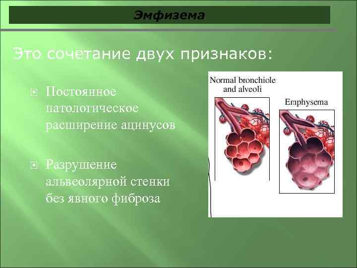 Эмфизема Это сочетание двух признаков: Постоянное патологическое расширение ацинусов Разрушение альвеолярной стенки без явного