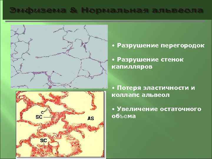  • Разрушение перегородок • Разрушение стенок капилляров • Потеря эластичности и коллапс альвеол