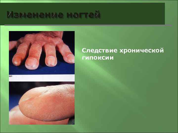 Следствие хронической гипоксии 