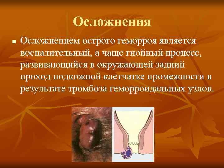 Осложнения n Осложнением острого геморроя является воспалительный, а чаще гнойный процесс, развивающийся в окружающей